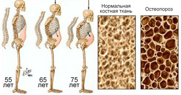 Как газировка (кофеин) влияют на костную ткань